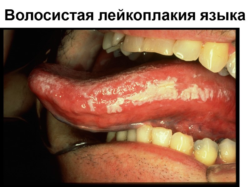 Волосистая лейкоплакия языка